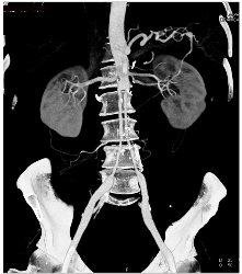 S/p Repair for Ehlers-Danlos Syndrome - CTisus CT Scan