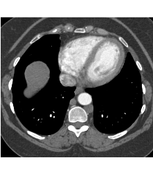 Excellent Contrast Throughout Aorta With Subsecond Flash Acquisition and Bolus Triggering - CTisus CT Scan