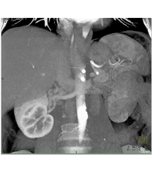 Normal Mesenteric Arcade - CTisus CT Scan