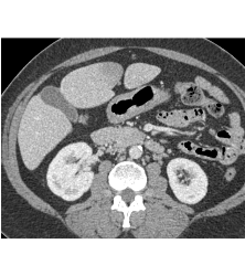 Occluded IVC With Collaterals - CTisus CT Scan