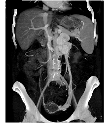 Occluded IVC With Collaterals - CTisus CT Scan