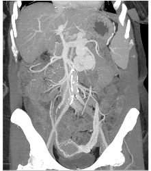 Huge Varices With Dilated Gonadal Vein - CTisus CT Scan