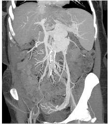 Huge Varices With Dilated Gonadal Vein - CTisus CT Scan