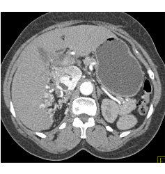 Renal Cell Carcinoma Invades Inferior Vena Cava (IVC) and Extends Into Atrium - CTisus CT Scan