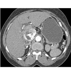 Renal Cell Carcinoma Invades Inferior Vena Cava (IVC) and Extends Into Atrium - CTisus CT Scan