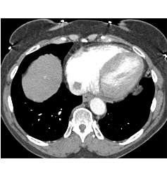 Renal Cell Carcinoma Invades Inferior Vena Cava (IVC) and Extends Into Atrium - CTisus CT Scan