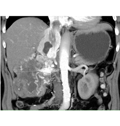 Renal Cell Carcinoma Invades Inferior Vena Cava (IVC) and Extends Into Atrium - CTisus CT Scan