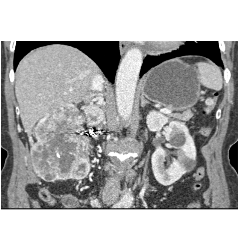 Renal Cell Carcinoma Invades Inferior Vena Cava (IVC) and Extends Into Atrium - CTisus CT Scan