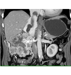 Renal Cell Carcinoma Invades Inferior Vena Cava (IVC) and Extends Into Atrium - CTisus CT Scan