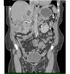 Renal Cell Carcinoma Invades Inferior Vena Cava (IVC) and Extends Into Atrium - CTisus CT Scan