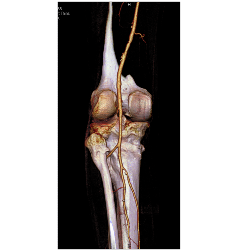 Peripheral Vascular Disease (PVD) Runoff - CTisus CT Scan