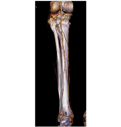 Peripheral Vascular Disease (PVD) Runoff - CTisus CT Scan