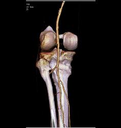 Popliteal Artery With Disease in Trifurcation Vessels- See Full Sequence - CTisus CT Scan