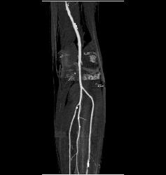 Popliteal Artery With Disease in Trifurcation Vessels- See Full Sequence - CTisus CT Scan