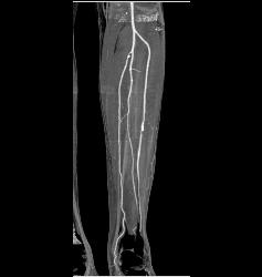 Popliteal Artery With Disease in Trifurcation Vessels- See Full Sequence - CTisus CT Scan