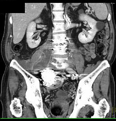 Iliac Artery Aneurysm With Iliopsoas Bleed - CTisus CT Scan