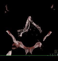 Iliac Artery Aneurysm With Iliopsoas Bleed - CTisus CT Scan