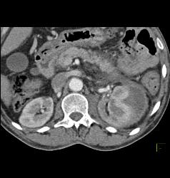 Page Kidney With Bleeding Splenic Artery Aneurysm- See Sequence - CTisus CT Scan