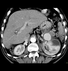 Page Kidney With Bleeding Splenic Artery Aneurysm- See Sequence - CTisus CT Scan