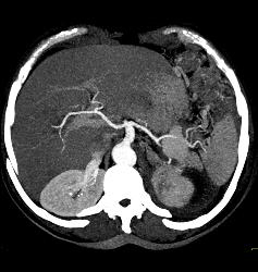 Page Kidney With Bleeding Splenic Artery Aneurysm- See Sequence - CTisus CT Scan