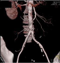 Stenosis At Anastomosis of Iliac Arteries to Aorta - CTisus CT Scan