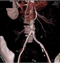 Stenosis At Anastomosis of Iliac Arteries to Aorta - CTisus CT Scan