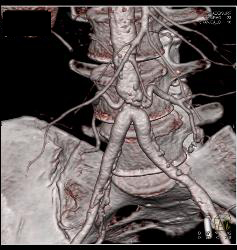 Stenosis At Anastomosis of Iliac Arteries to Aorta - CTisus CT Scan