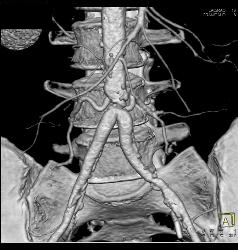 Stenosis At Anastomosis of Iliac Arteries to Aorta - CTisus CT Scan