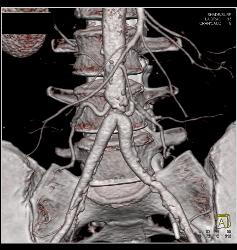 Stenosis At Anastomosis of Iliac Arteries to Aorta - CTisus CT Scan