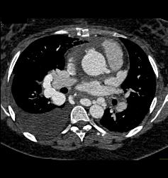 Pulmonary Vascular Malformations - CTisus CT Scan