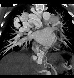 Pulmonary Vascular Malformations - CTisus CT Scan