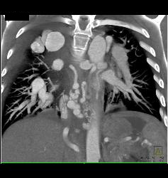 Pulmonary Vascular Malformations - CTisus CT Scan