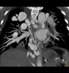 Pulmonary Vascular Malformations - CTisus CT Scan