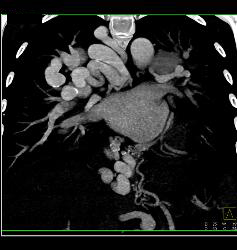 Pulmonary Vascular Malformations - CTisus CT Scan