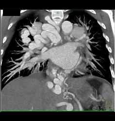 Pulmonary Vascular Malformations - CTisus CT Scan