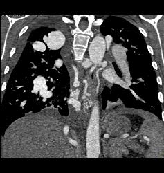 Pulmonary Vascular Malformations - CTisus CT Scan