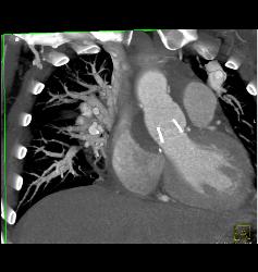 Pulmonary Vascular Malformations - CTisus CT Scan