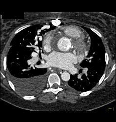 Pulmonary Vascular Malformations - CTisus CT Scan