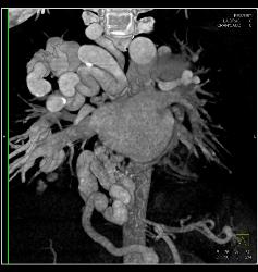 Pulmonary Vascular Malformations - CTisus CT Scan