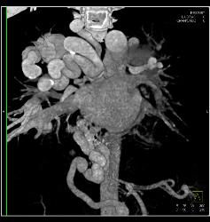 Pulmonary Vascular Malformations - CTisus CT Scan