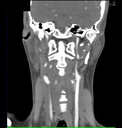 Normal Carotid Arteries for Editing and Pseudolesions - CTisus CT Scan