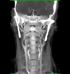 Normal Carotid Arteries for Editing and Pseudolesions - CTisus CT Scan