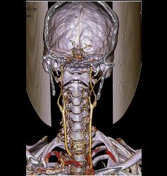 Normal Carotid Arteries for Editing and Pseudolesions - CTisus CT Scan