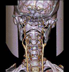 Normal Carotid Arteries for Editing and Pseudolesions - CTisus CT Scan