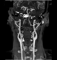 Normal Carotid Arteries for Editing and Pseudolesions - CTisus CT Scan