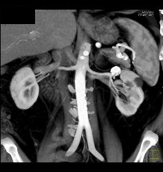 Renal Artery Aneurysm - CTisus CT Scan