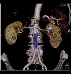 Renal Artery Aneurysm - CTisus CT Scan