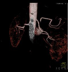 Renal Artery Stenosis - CTisus CT Scan