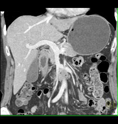 Renal Artery Stenosis - CTisus CT Scan