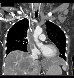 SVC Occlusion With Huge Collaterals and Thrombus Into Right Atrium - CTisus CT Scan